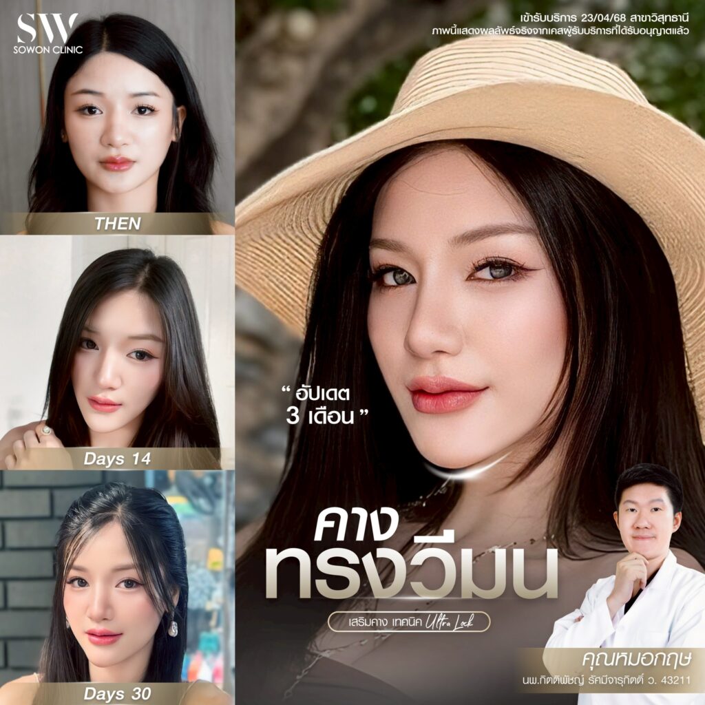 เสริมคาง 12