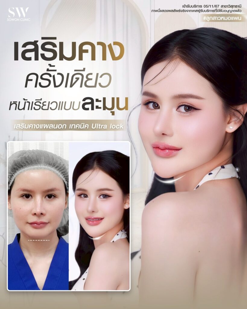 เสริมคาง 13