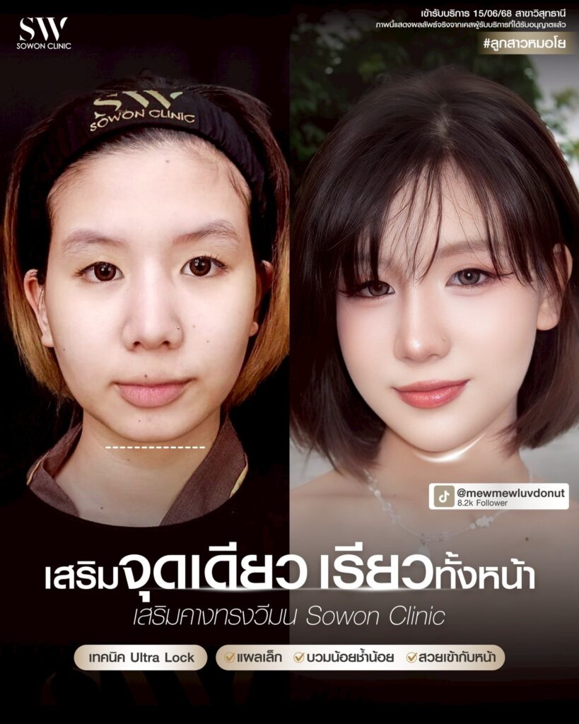 เสริมคาง 14