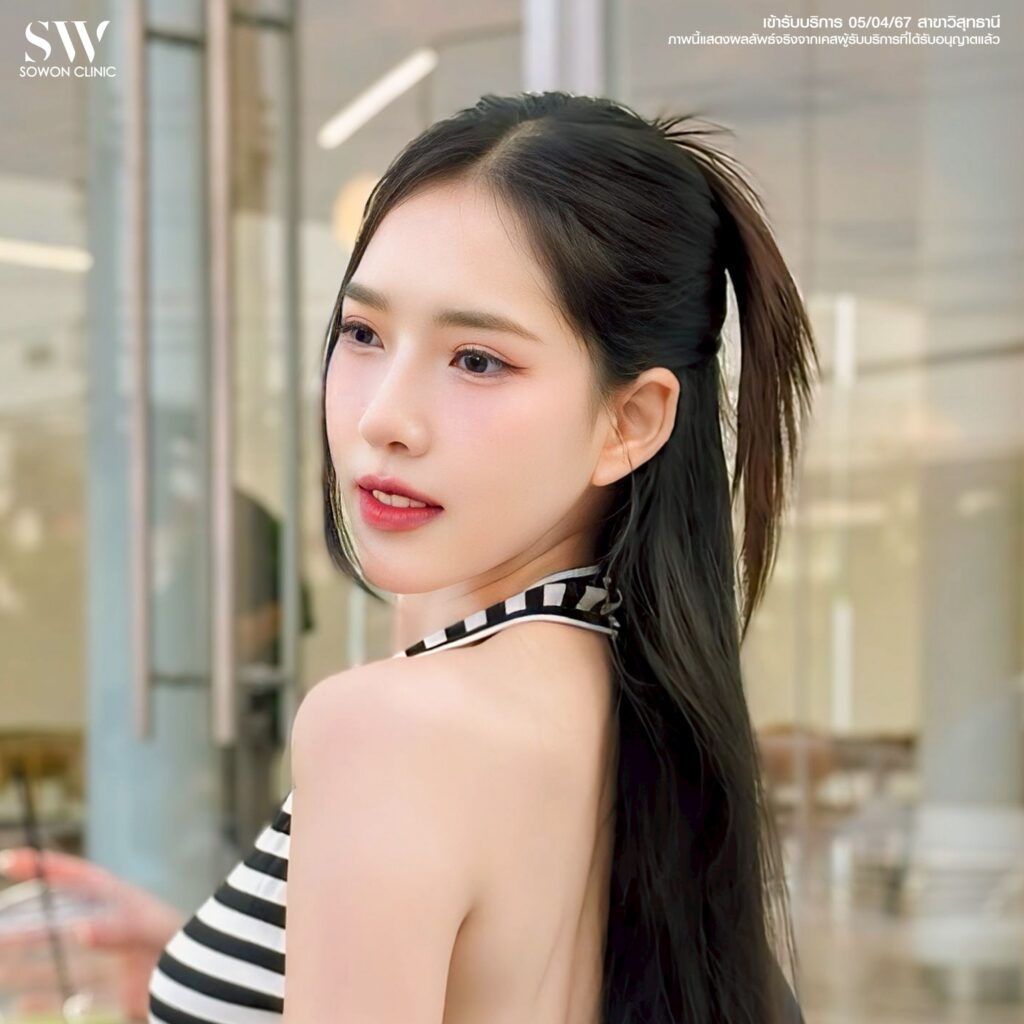 เสริมคาง 16