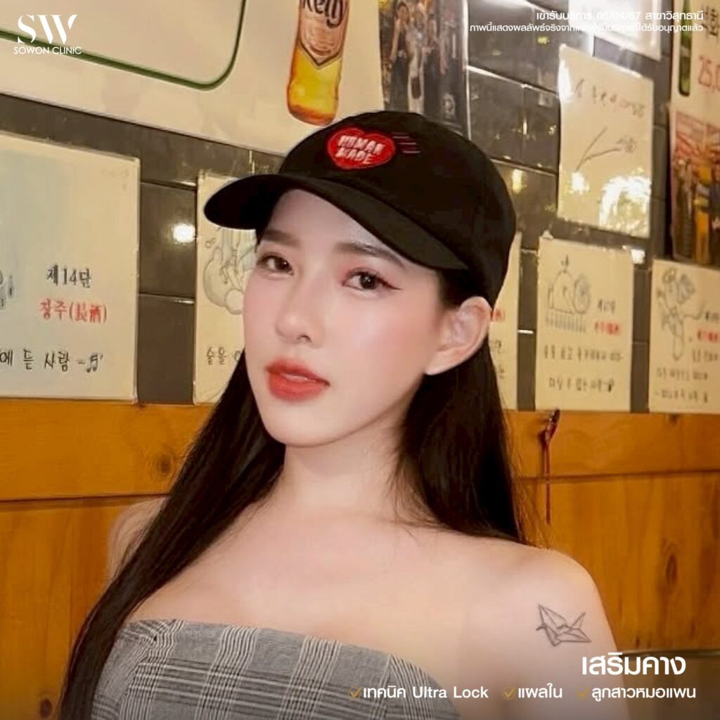 เสริมคาง 19