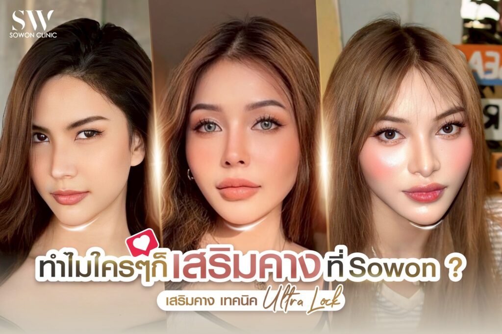 เสริมคาง 2