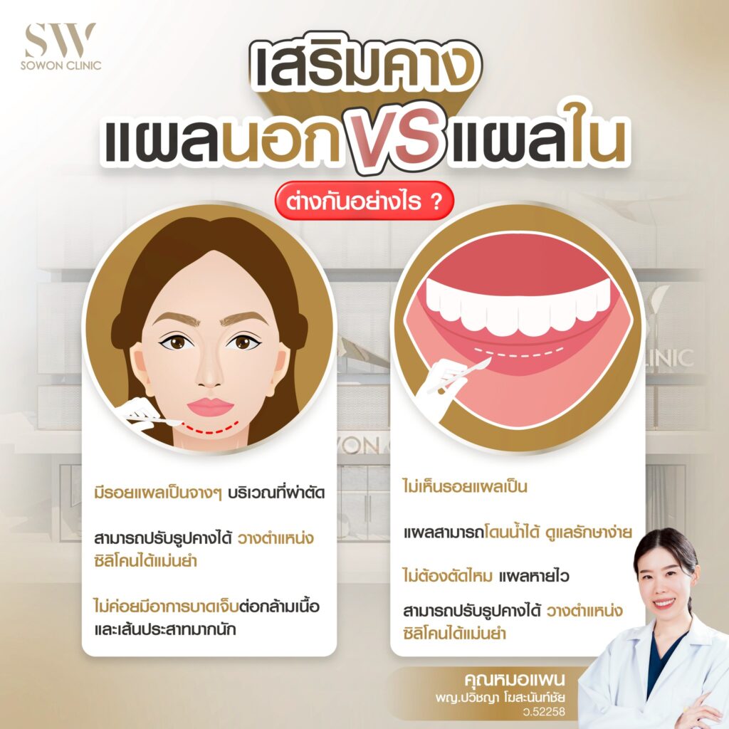 เสริมคาง 9.