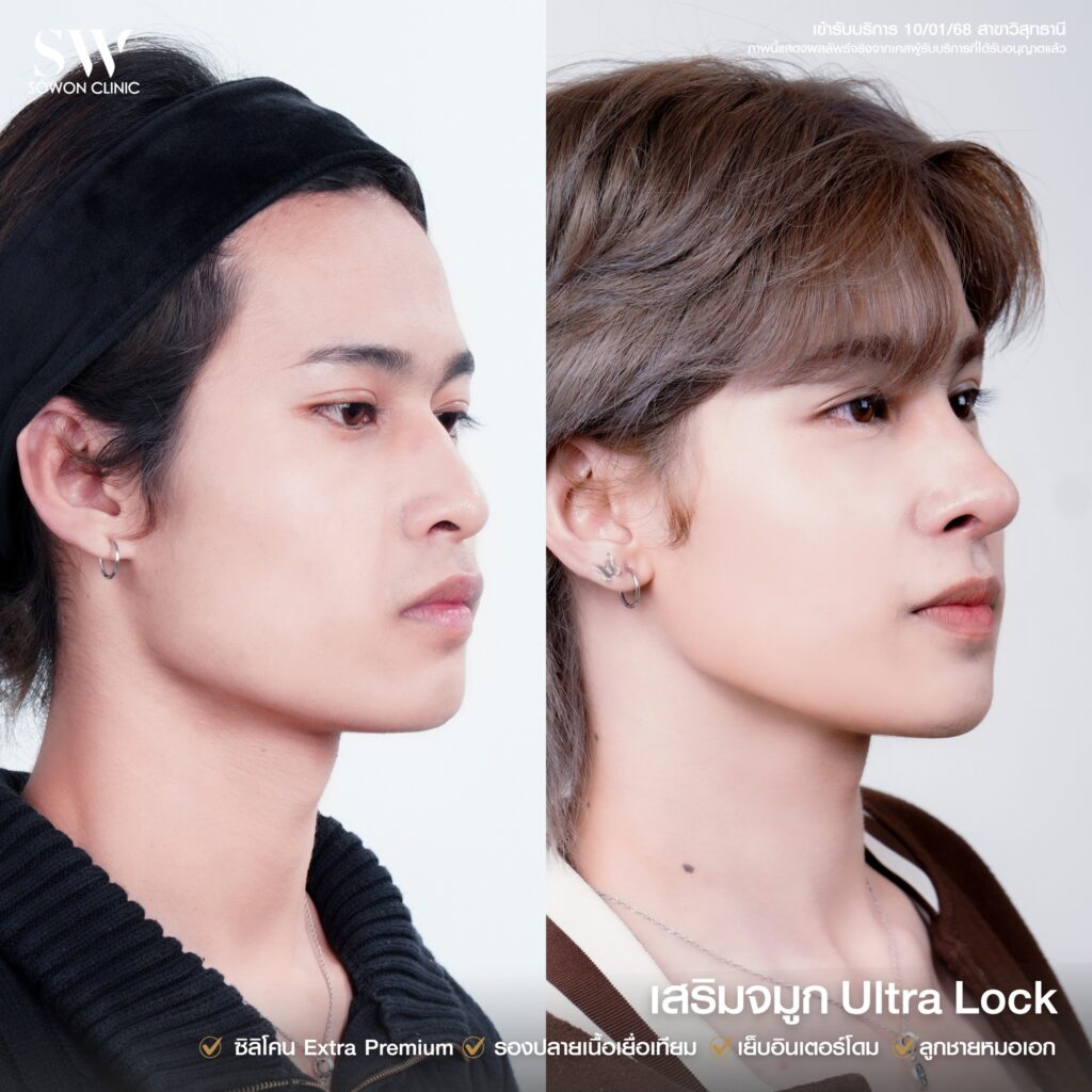 เสริมจมูก 011