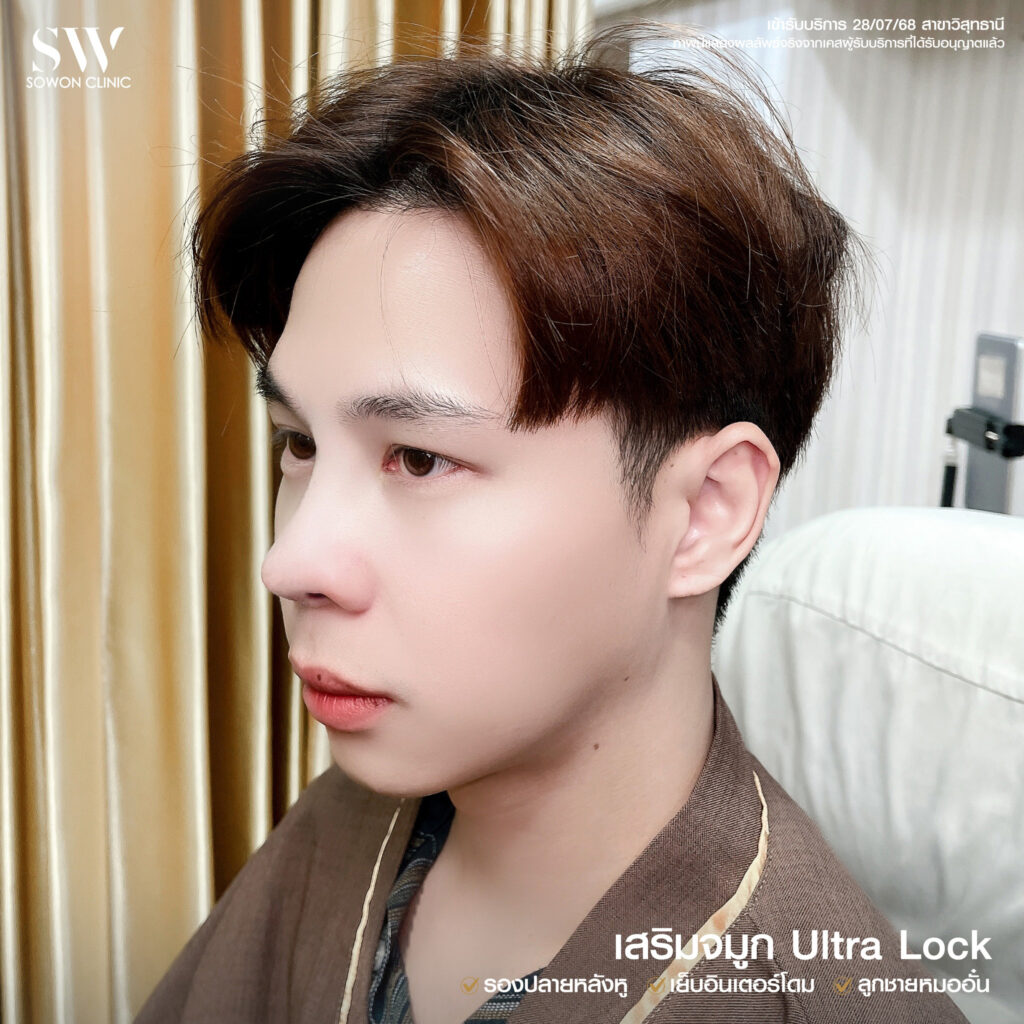 เสริมจมูก 5