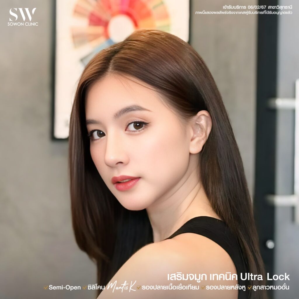 เสริมจมูก 6