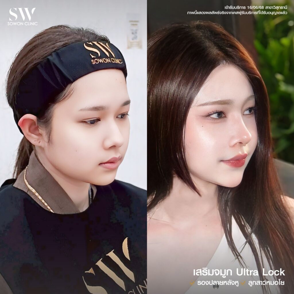 เสริมจมูก 9