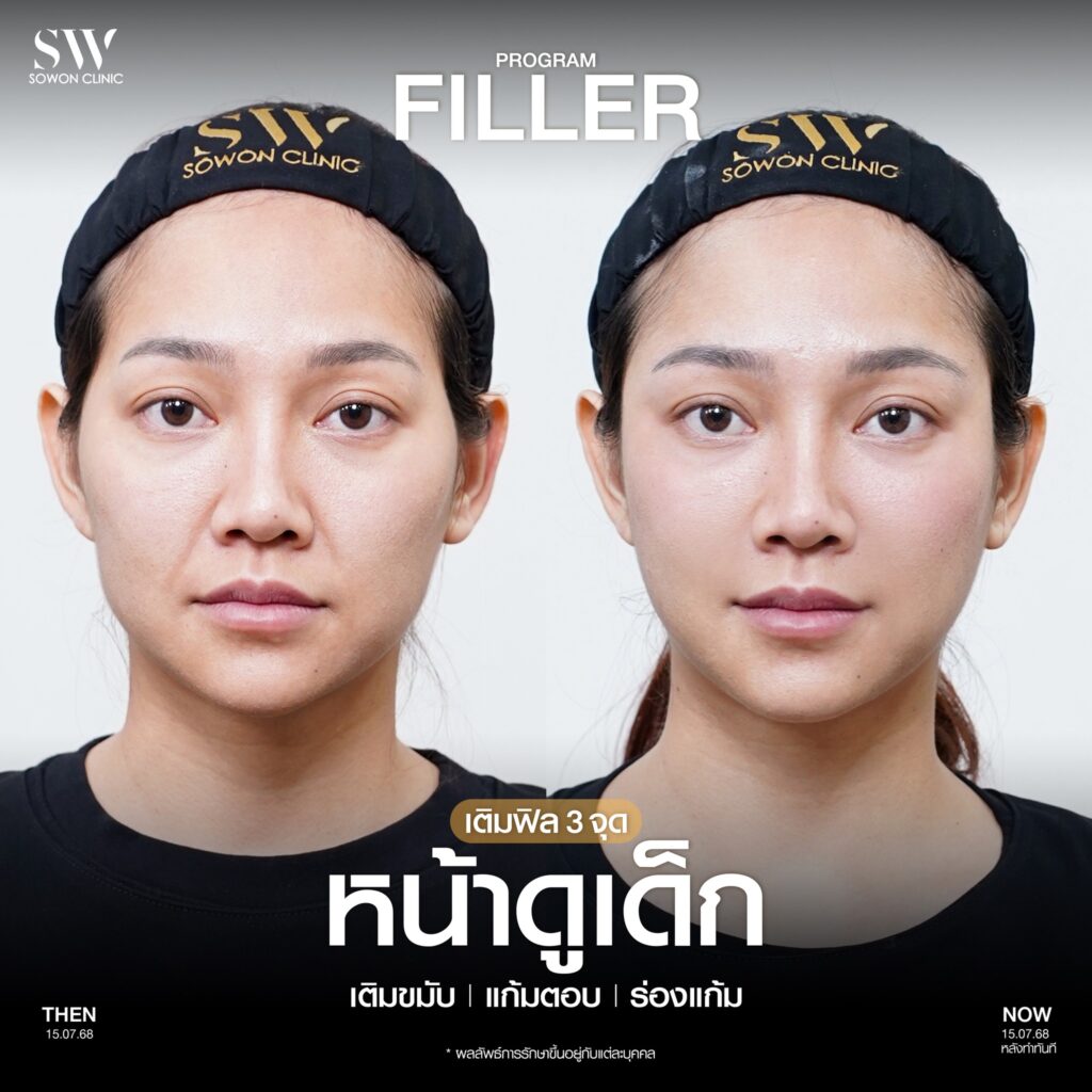 แก้มตอบ แก้มยกด้วยฟิลเลอร์ รีวิว01