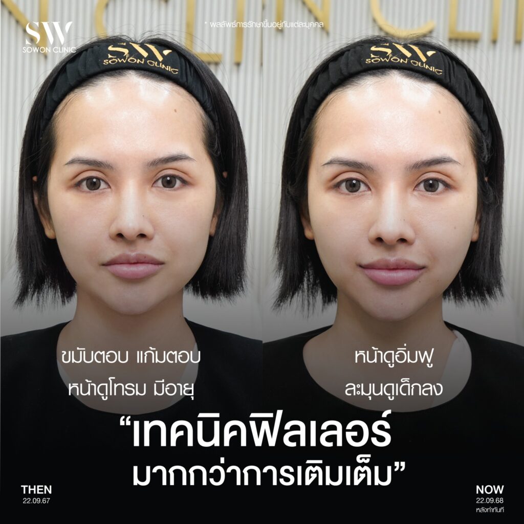 แก้มตอบ แก้มยกด้วยฟิลเลอร์ รีวิว02