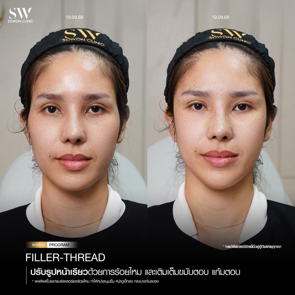 แก้มตอบ แก้มยกด้วยฟิลเลอร์ รีวิว03