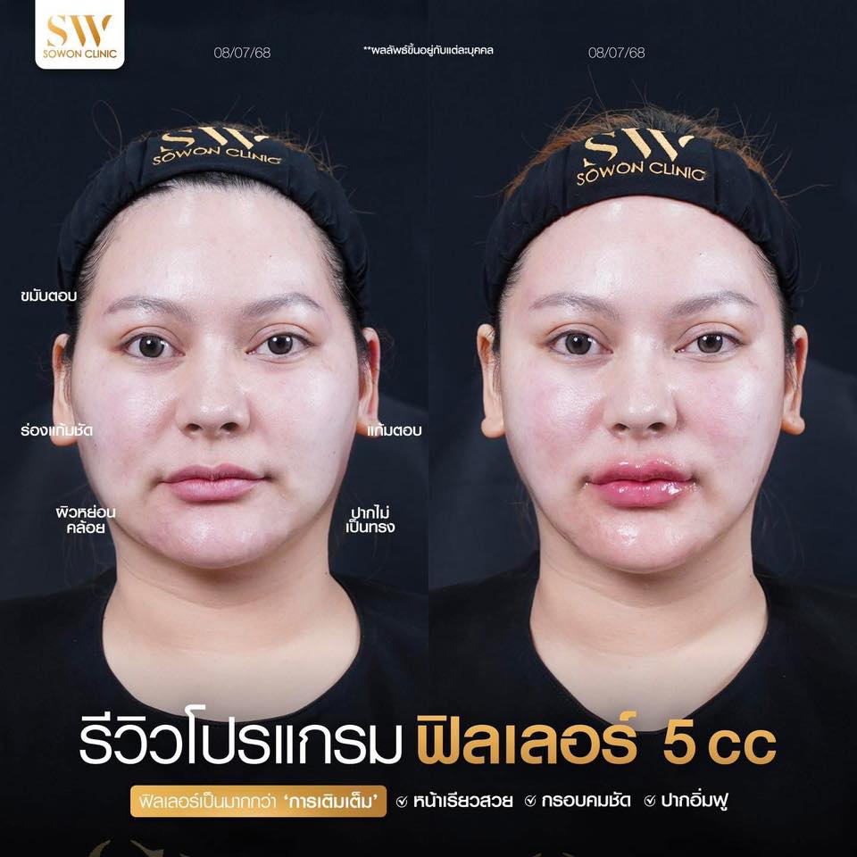 แก้มตอบ แก้มยกด้วยฟิลเลอร์ รีวิว05