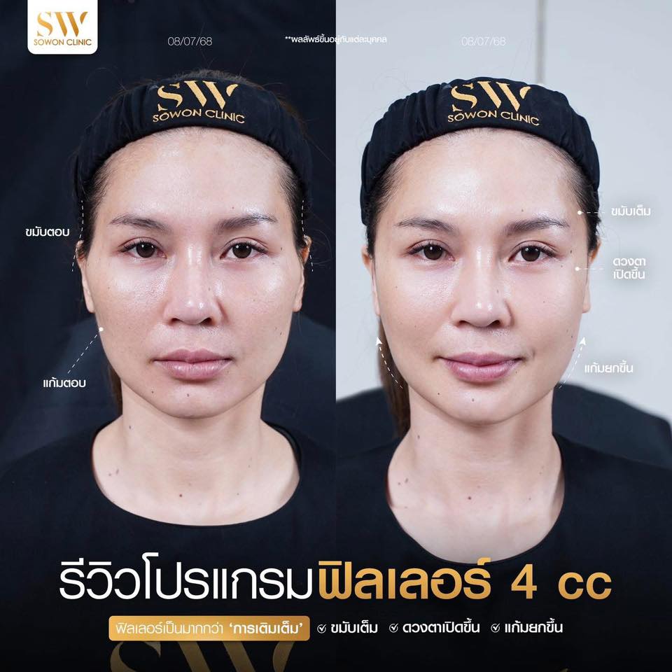 แก้มตอบ แก้มยกด้วยฟิลเลอร์ รีวิว04