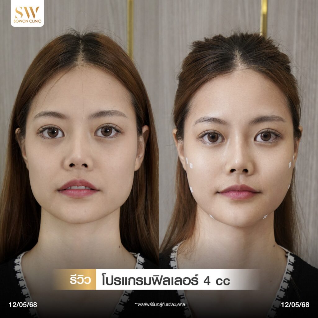 แก้มตอบ แก้มยกด้วยฟิลเลอร์ รีวิว07