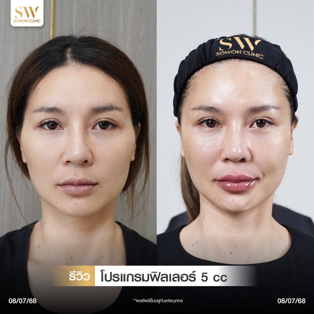 แก้มตอบ แก้มยกด้วยฟิลเลอร์ รีวิว08