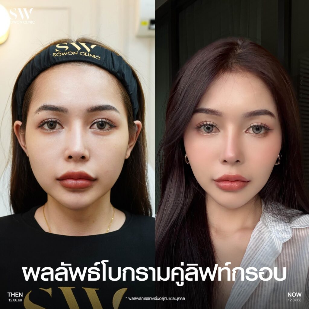 กรอบหน้าชัด โบกราม-โบลิฟ
