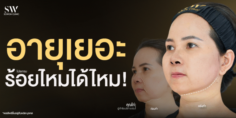 can-older-adults-get-thread-lift-skin-thread-knowledge