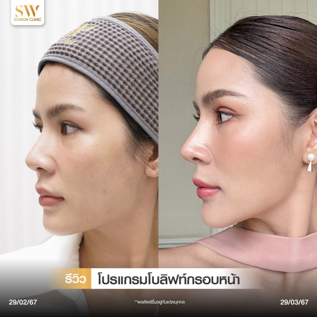 กรอบหน้าชัด รีวิวลิฟกรอบหน้า05