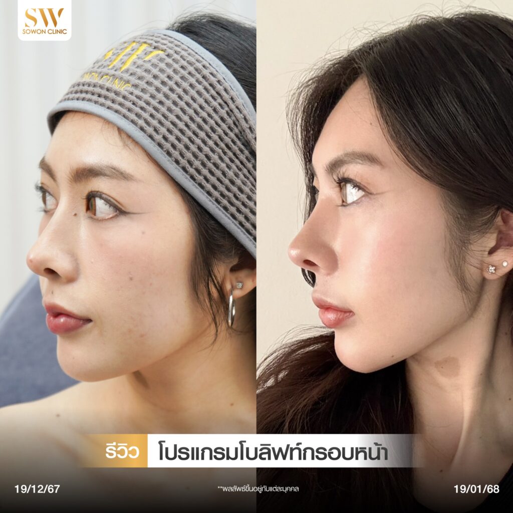 กรอบหน้าชัด รีวิวลิฟกรอบหน้า04