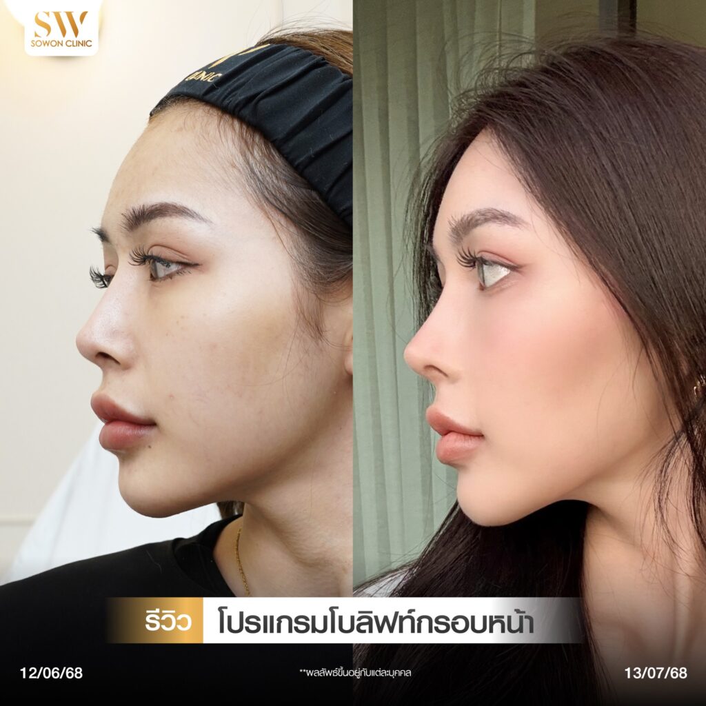 กรอบหน้าชัด รีวิวลิฟกรอบหน้า03