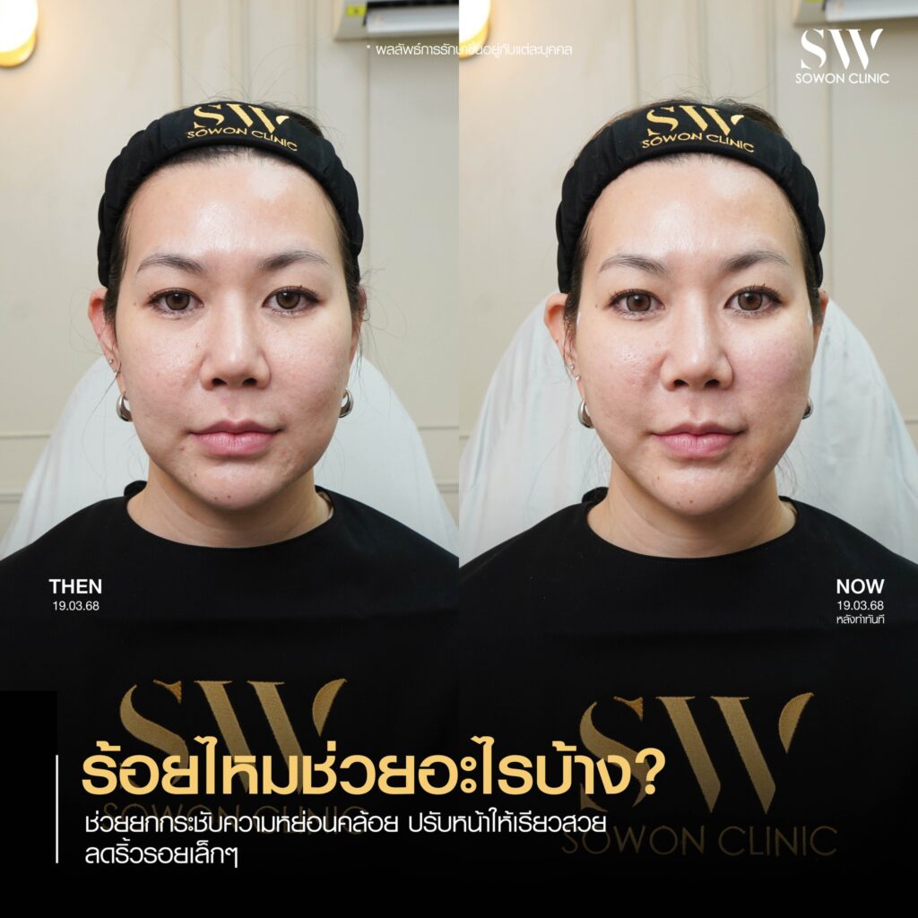 ยกกระชับหน้า ช่วยอะไร