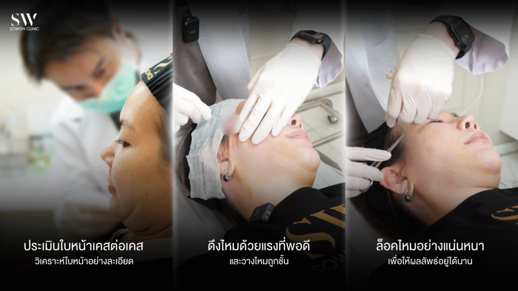 ยกกระชับหน้า เทคนิค Sowon clinic