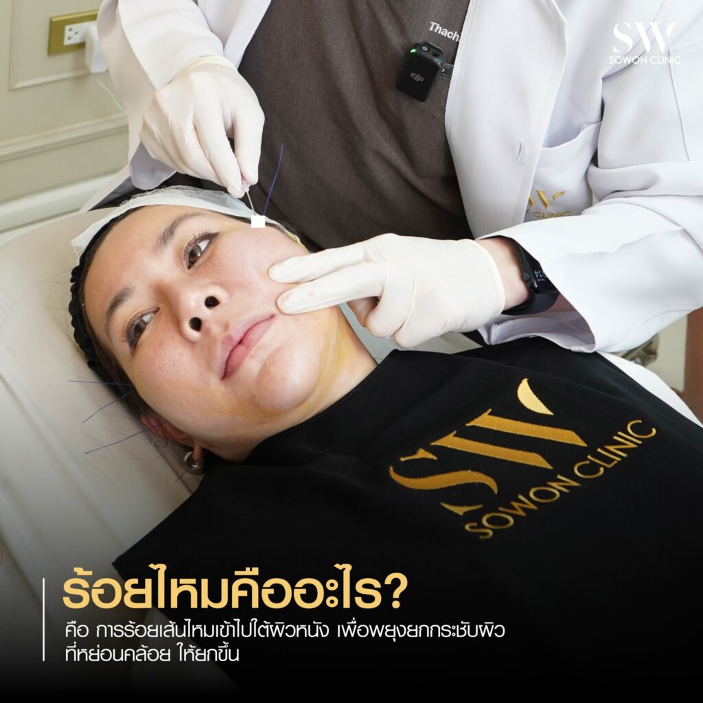 ยกกระชับหน้า ร้อยไหมคืออะไร