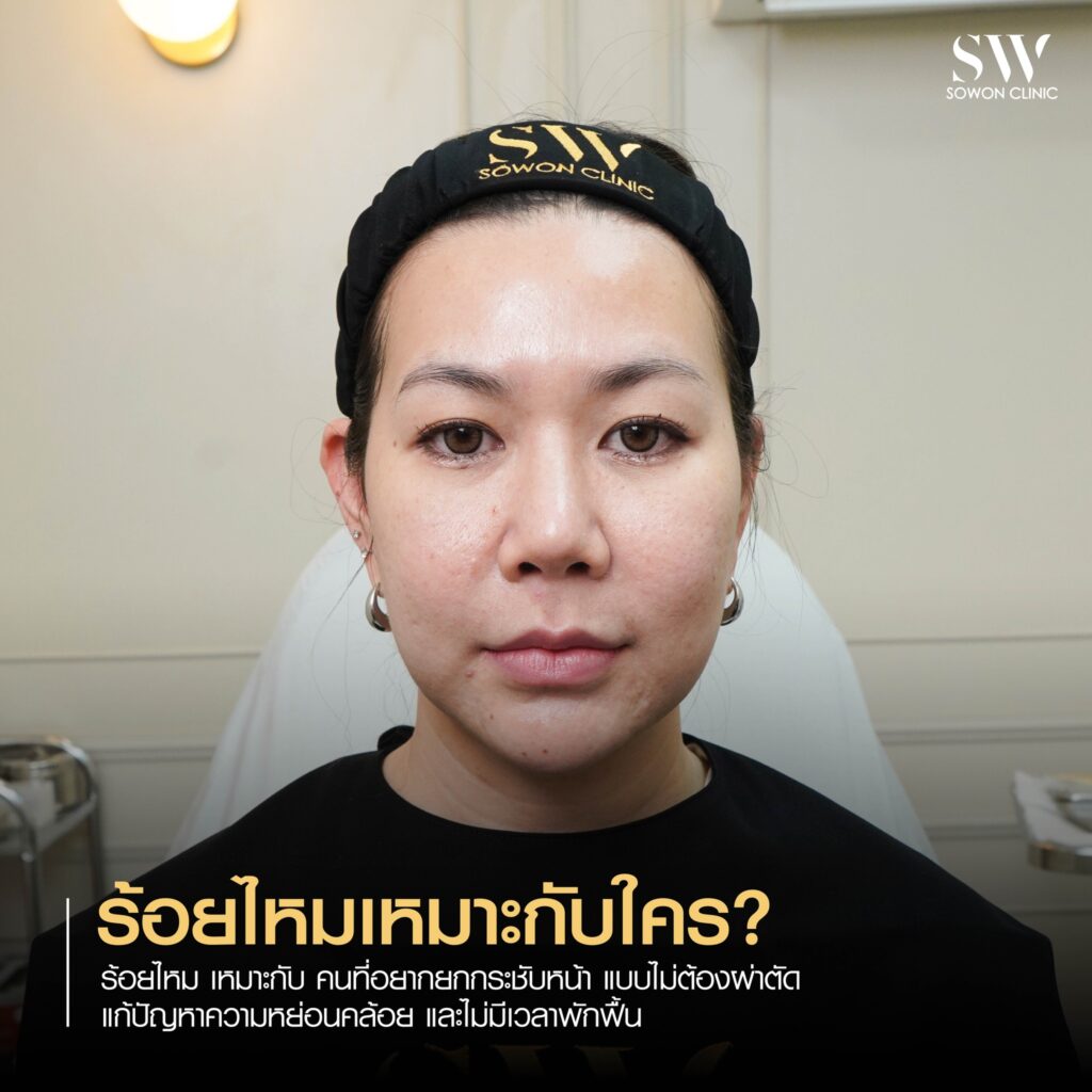 ยกกระชับหน้า เหมาะกับใคร