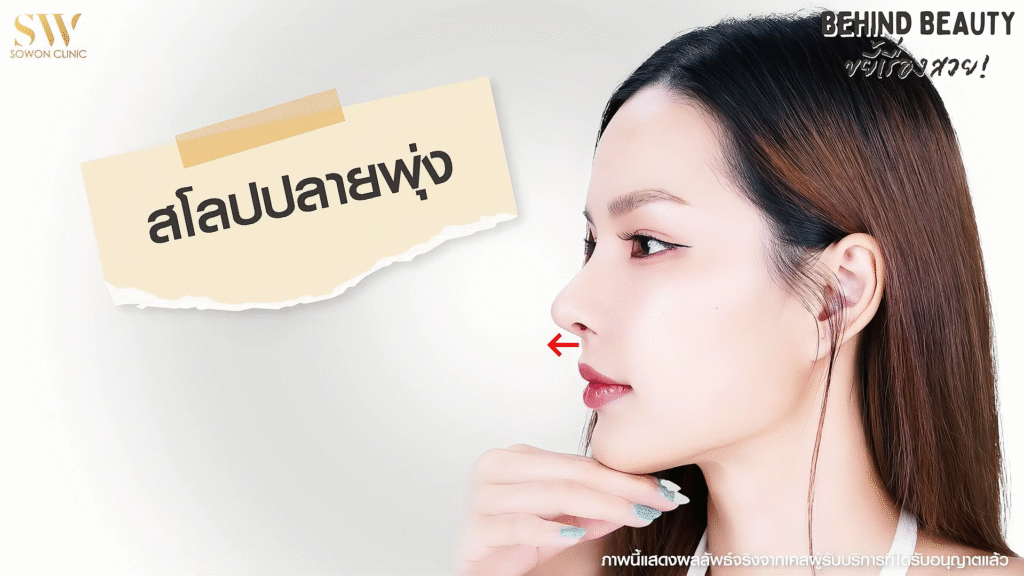 รีวิวเสริมจมูก ทรงจมูกสโลปปลายพุ่ง
