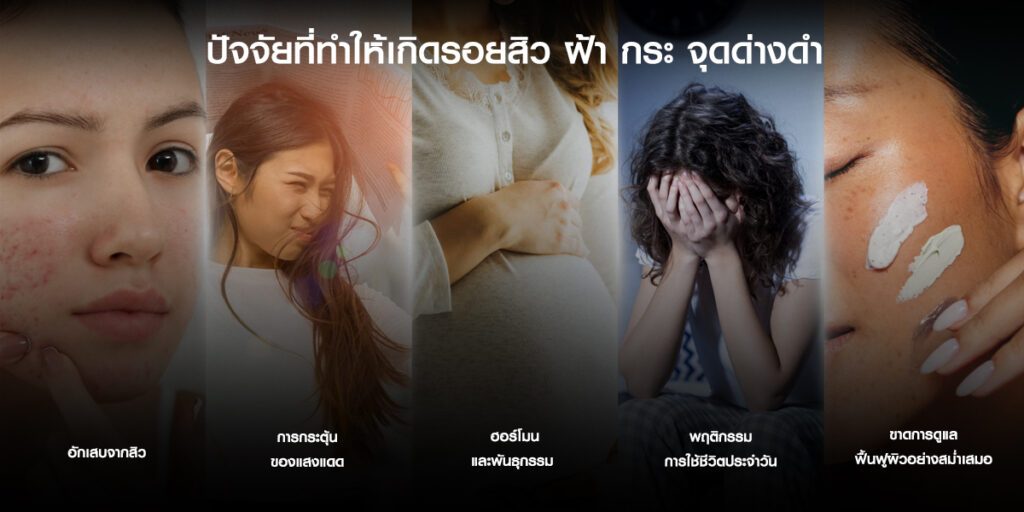 หน้าใส ปัจจัยที่ทำให้เกิดสิว