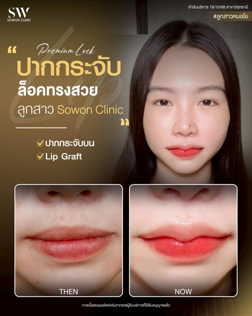 ปากกระจับ 