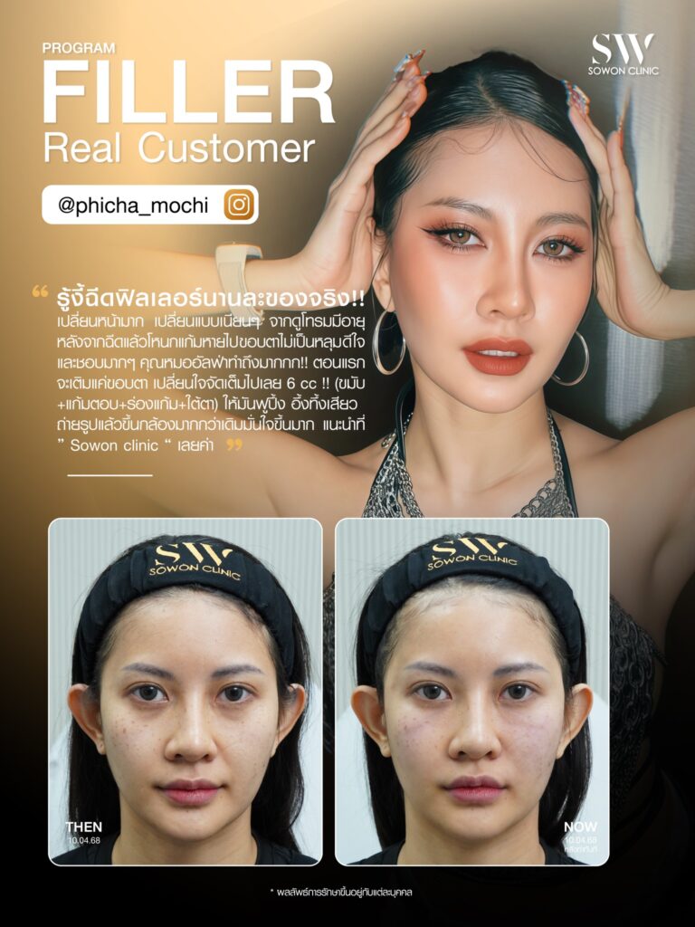 ฟิลเลอร 001