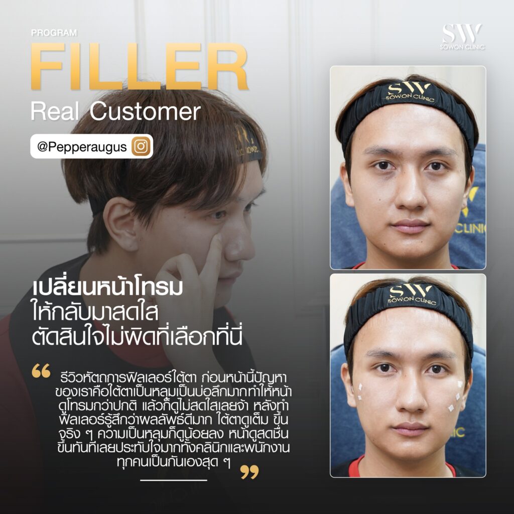 ฟิลเลอร 004