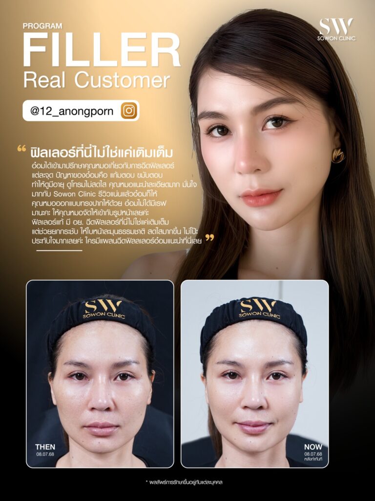 ฟิลเลอร 007