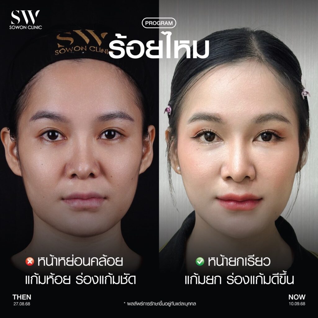 ร้อยไหม 01