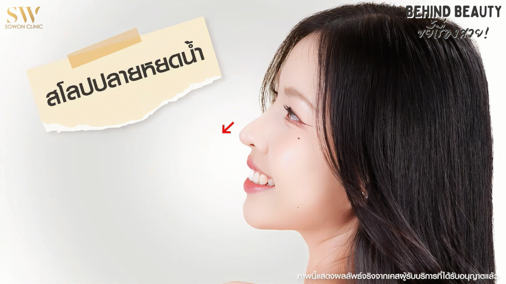 รีวิวเสริมจมูก จมูกสโลปปลายหยดน้ำ