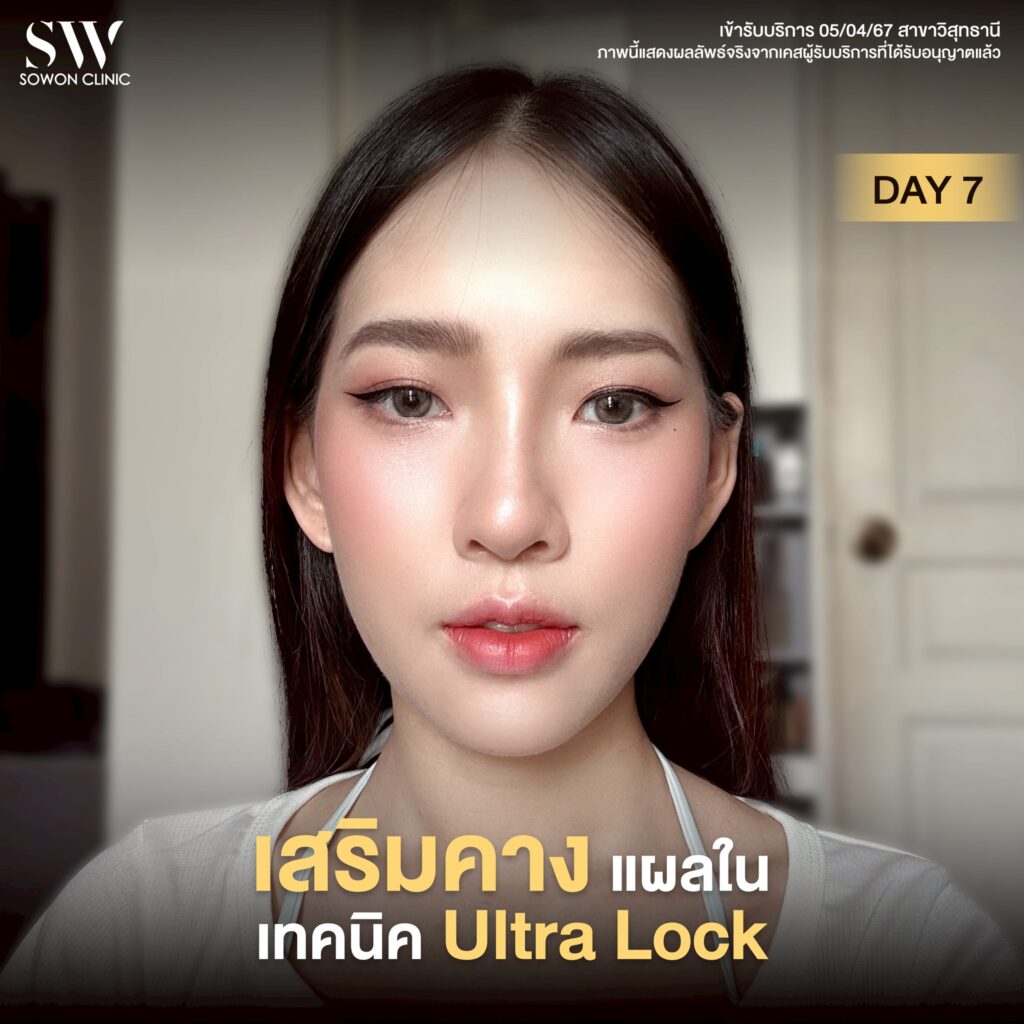 เสริมคาง 001