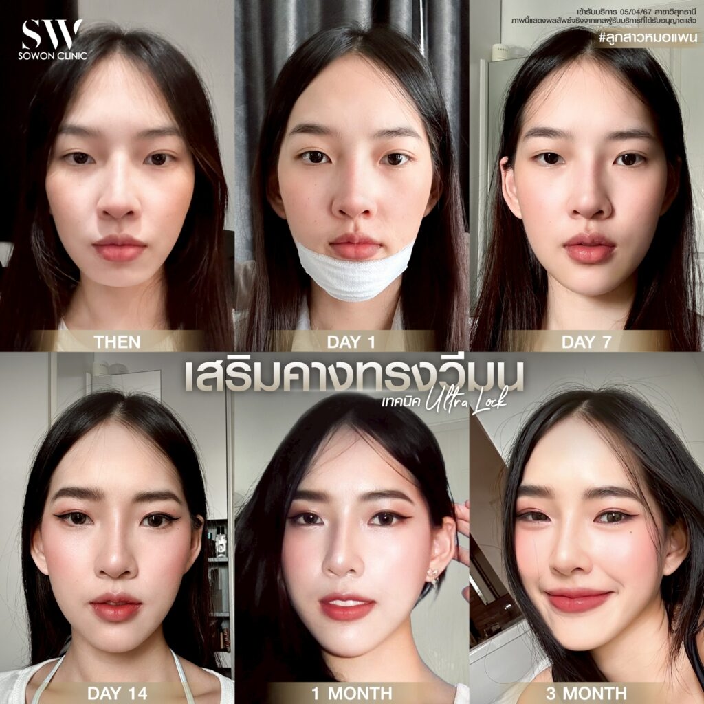 เสริมคาง 005