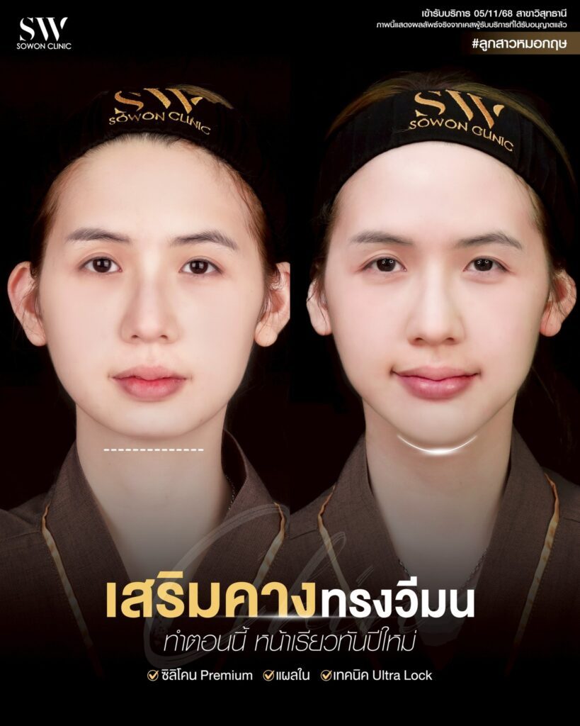 เสริมคาง 006