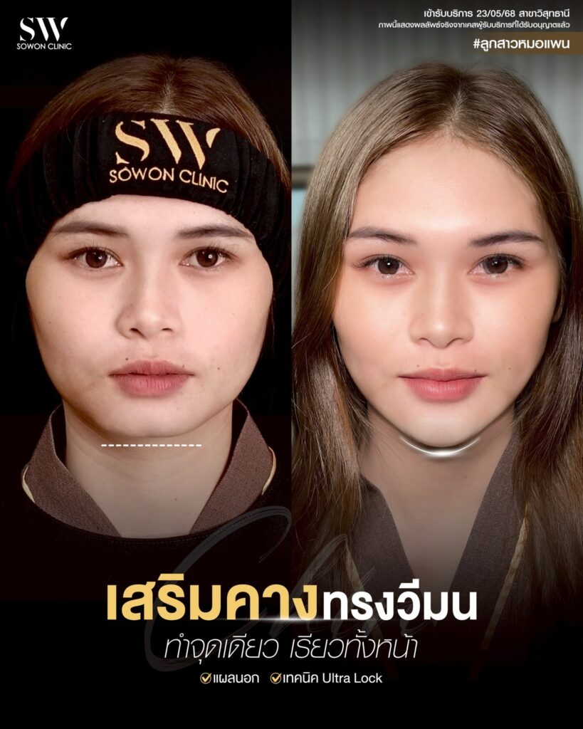 เสริมคาง 007