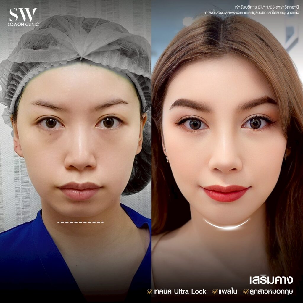 เสริมคาง 008