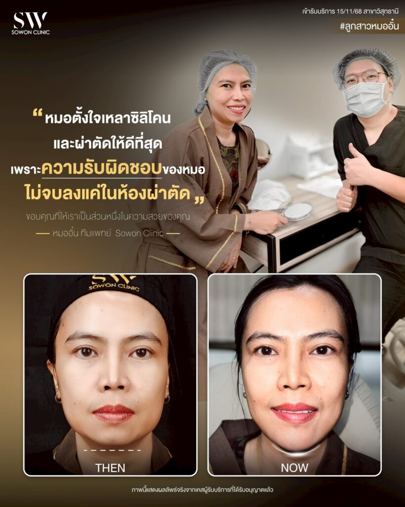 เสริมคาง 009