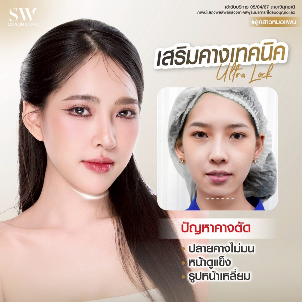 เสริมคาง 010