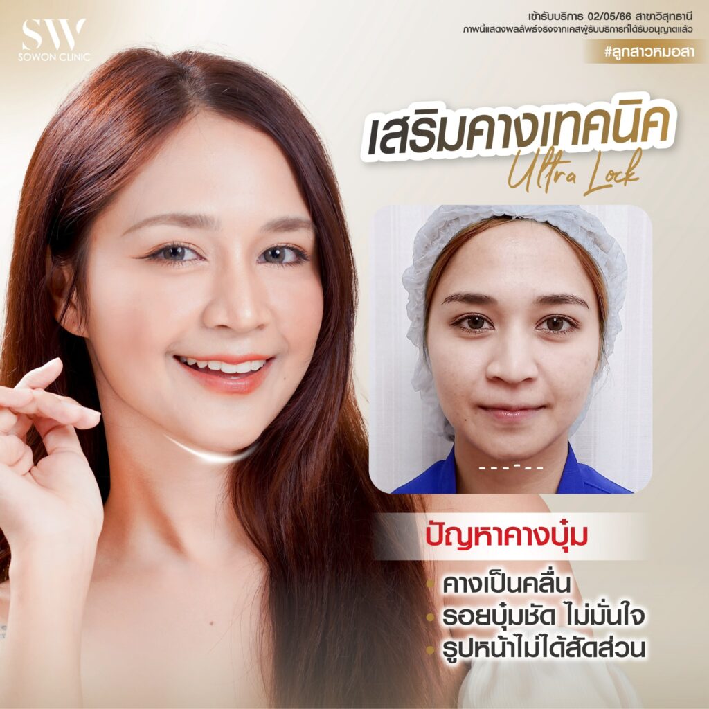เสริมคาง 011