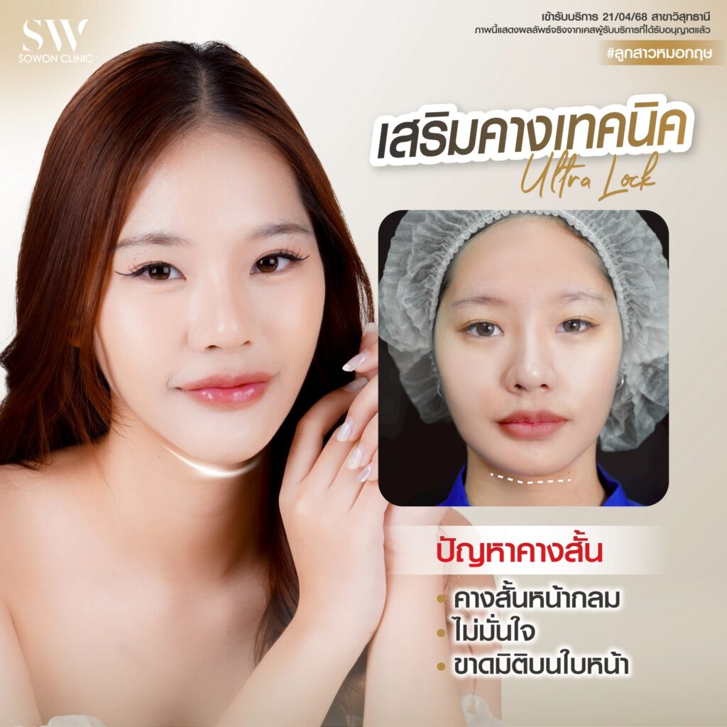 เสริมคาง 012