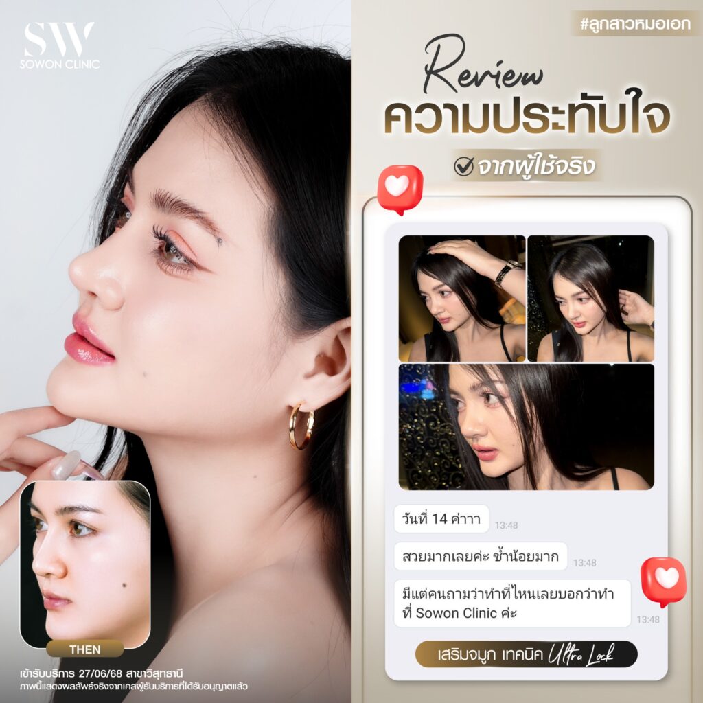 เสริมจมูก 001