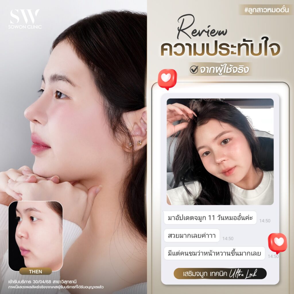 เสริมจมูก 002