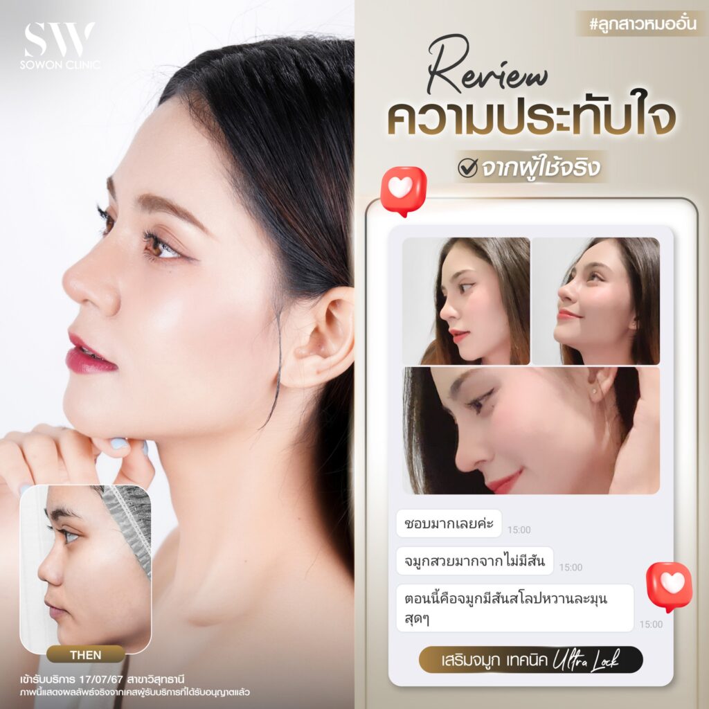 เสริมจมูก 003