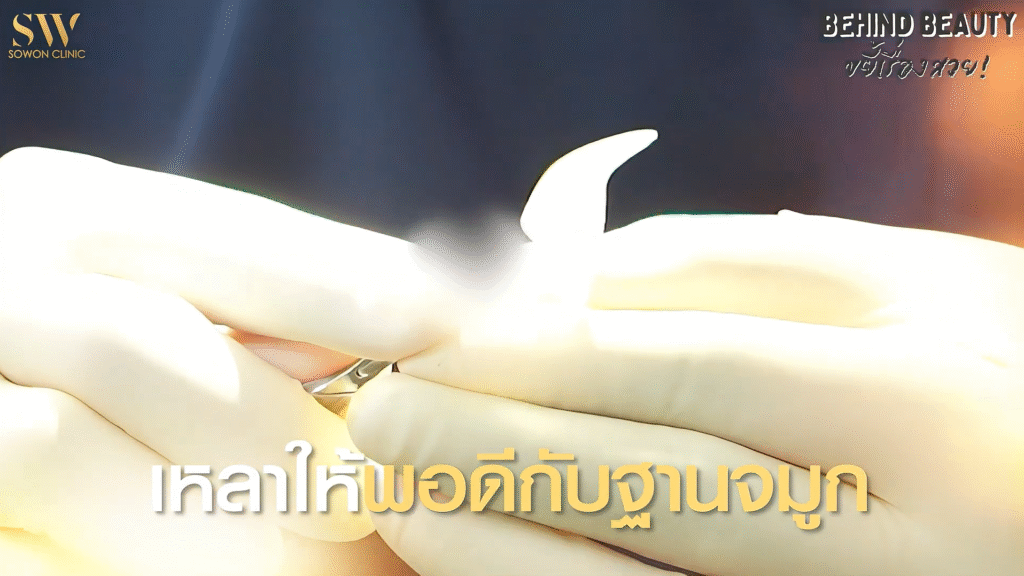 รีวิวเสริมจมูก เหลาพอดีกับฐาน