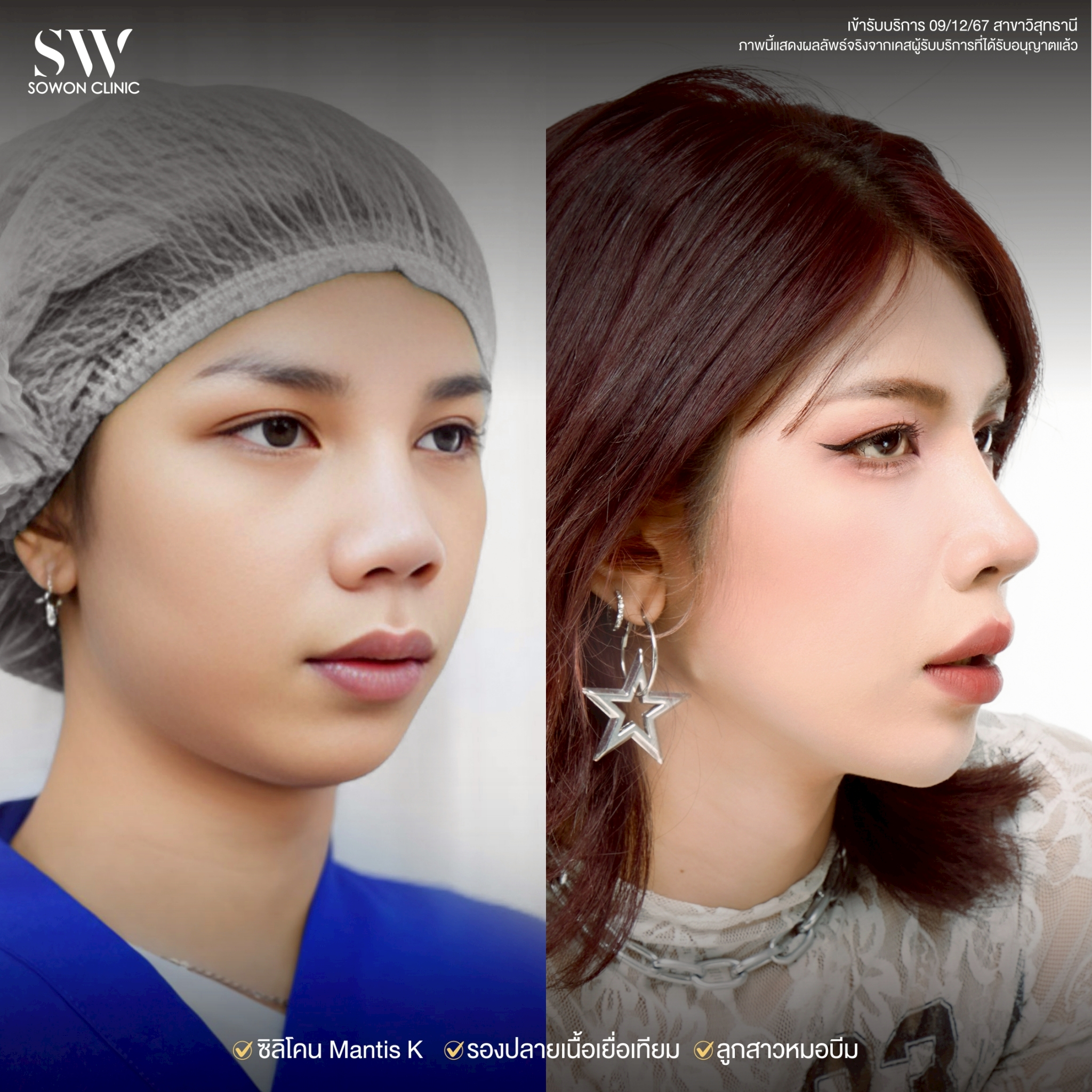 ทรงจมูก รีวิวลูกสาว Sowon Clinic11