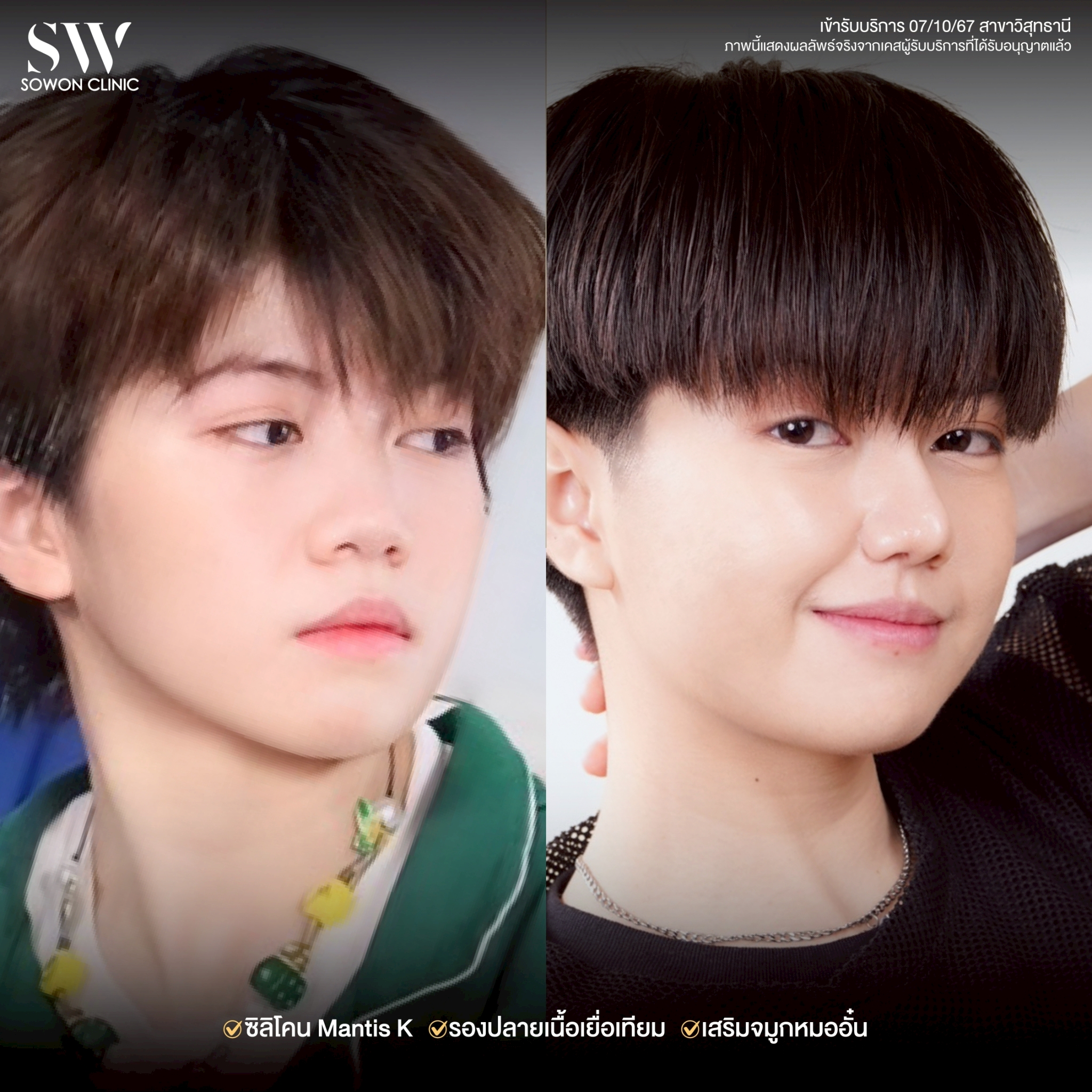 ทรงจมูก รีวิวลูกสาว Sowon Clinic2